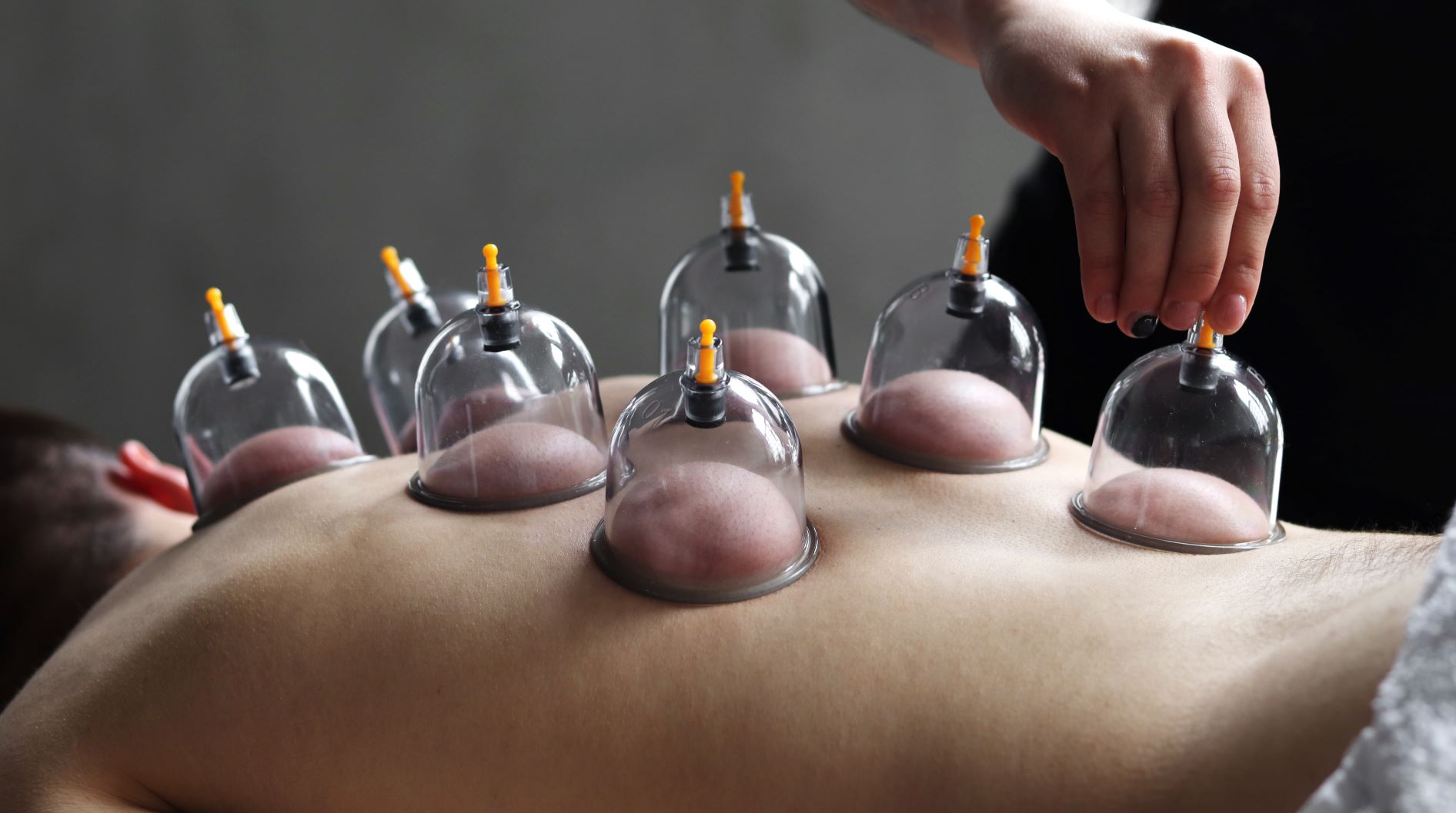 4 Session Package Cupping - 45 Minutes Each